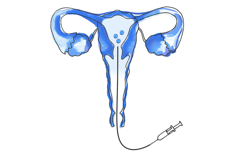 4. Transferencia embrionaria